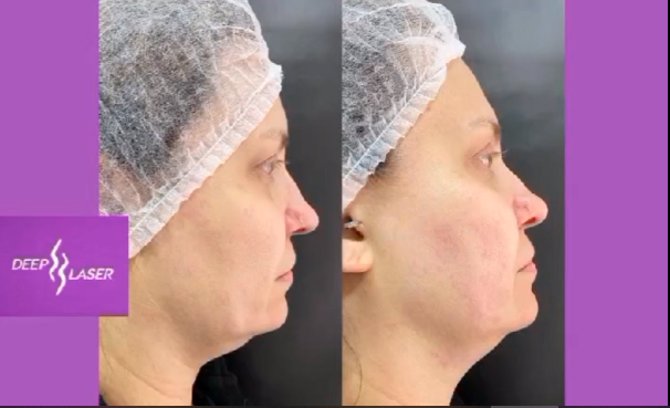 Ultraformer Antes e Depois
