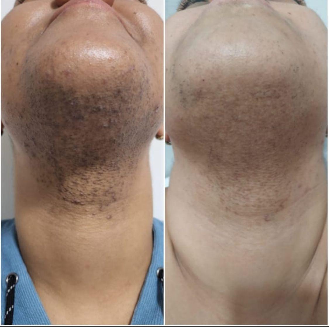 Depilação a Laser Ante e Depois