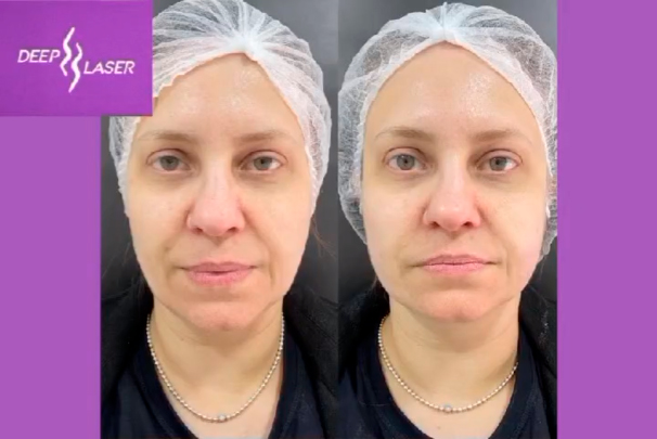 Ultraformer Antes e Depois