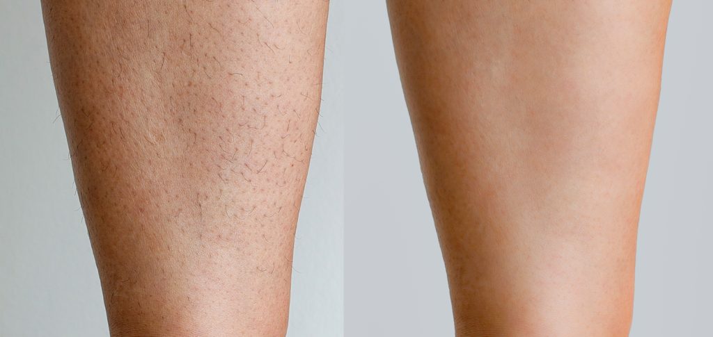 fotos mostrando os antes e depois da depilação a lazer nas pernas